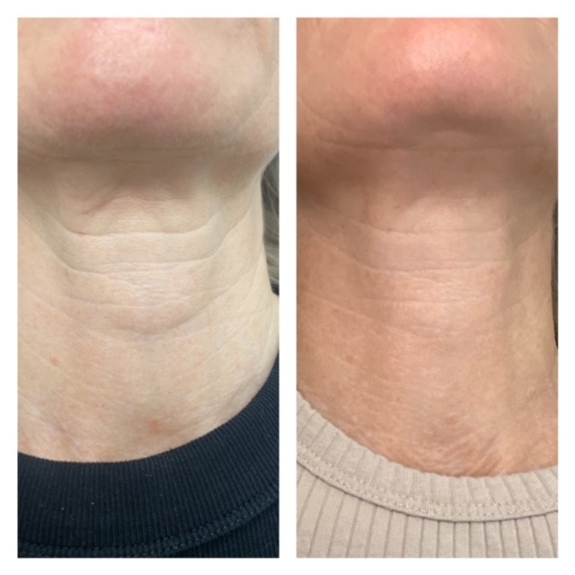 PDO_neck_front